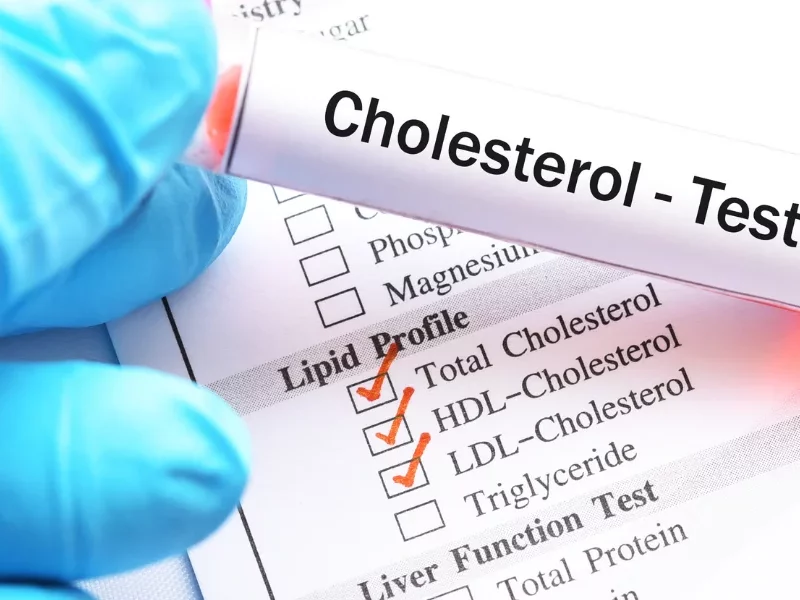 cholesterol-testing-los-angeles